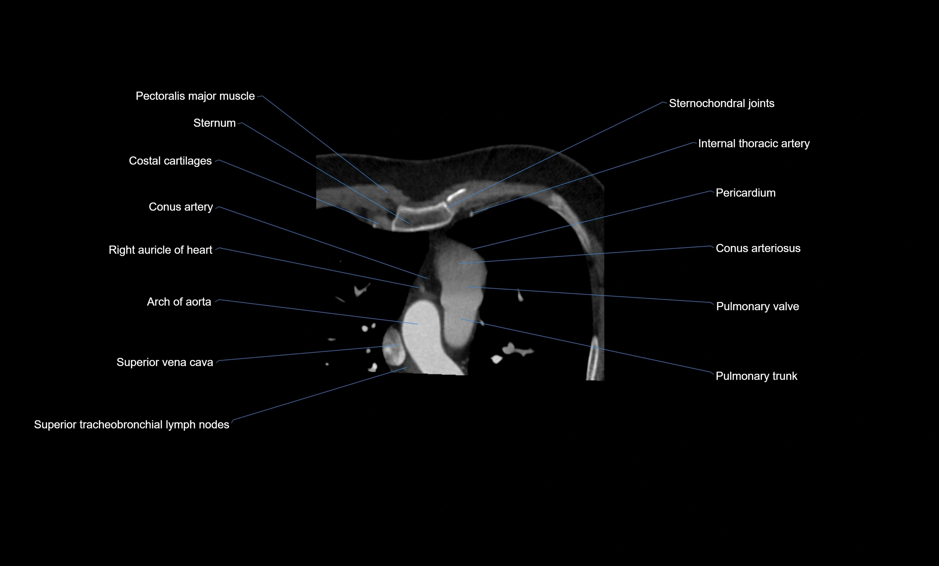 CT heart (coronary angiogram) four chamber view  cross sectional anatomy labelled radiology image -00011.webp
